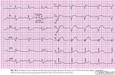 Электрокардиография ЭКГ