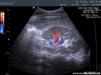 Эходоплерография сосудов полового члена с интракавертозным пистом